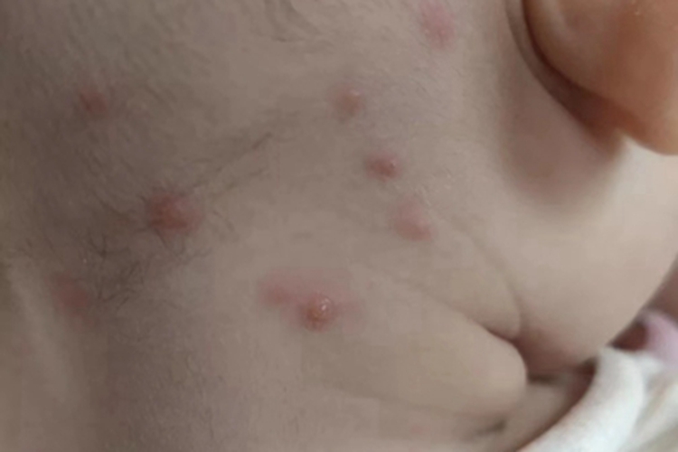 水痘侧颈部小红疙瘩图 水痘侧颈部小红疙瘩图