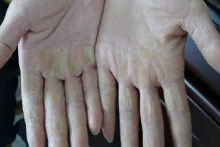 表皮松解性掌跖角皮症手掌皮肤发黄图