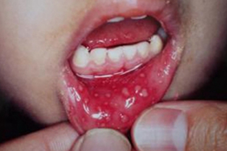 疱疹样溃疡唇内侧溃疡图