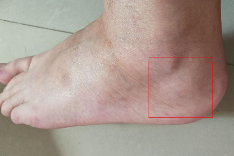 脚踝筋膜炎位置图