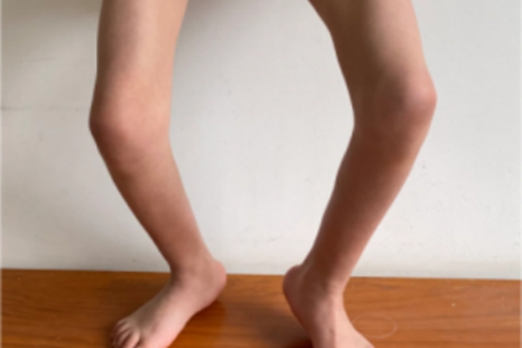 氟骨症双腿弯曲变形图