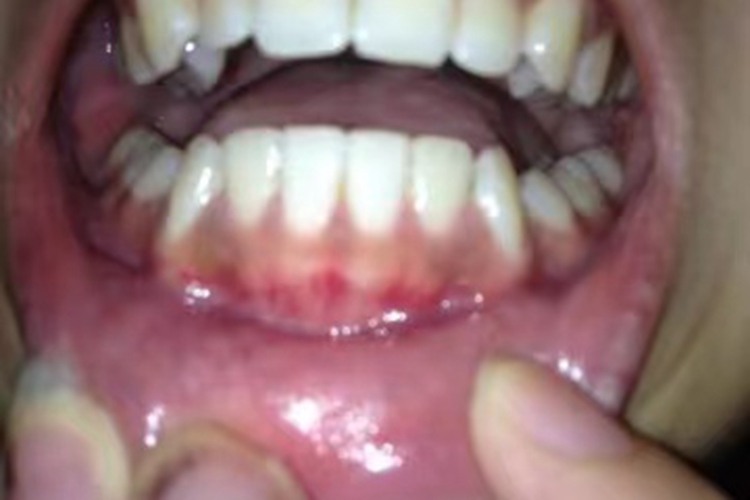 牙龈有一道横充血红线图