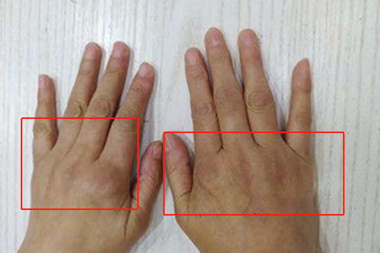 昆虫性皮炎手背肿图