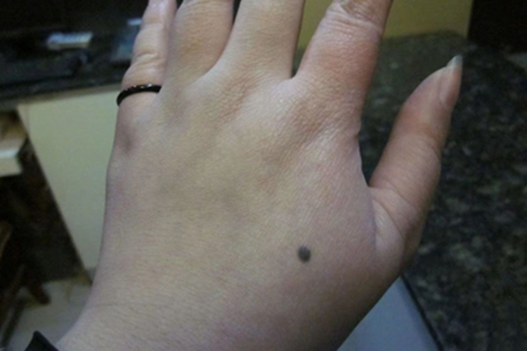 黑素细胞痣手背痣图 黑素细胞痣手背痣图