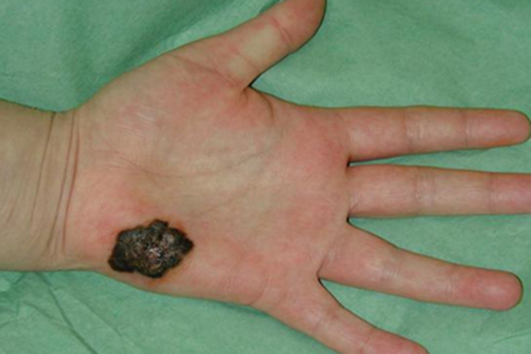 肢端雀斑痣样黑素瘤手掌症状图 肢端雀斑痣样黑素瘤手掌症状图