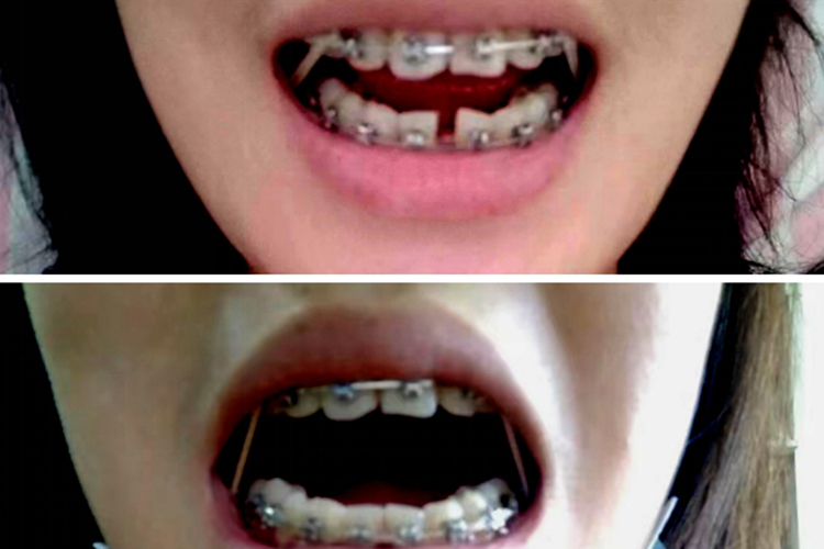 正畸拔下门牙效果图