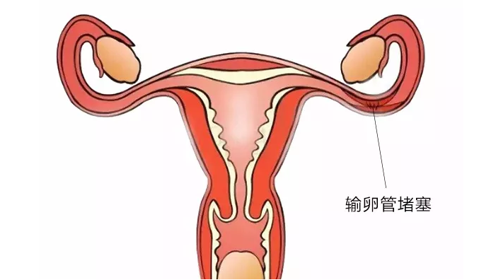 輸卵管堵塞一般有哪些症狀?