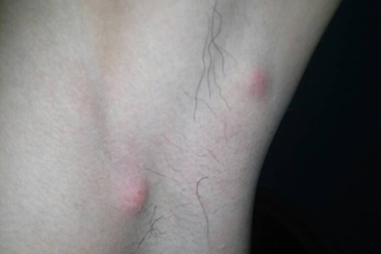 化脓性汗腺炎肿图