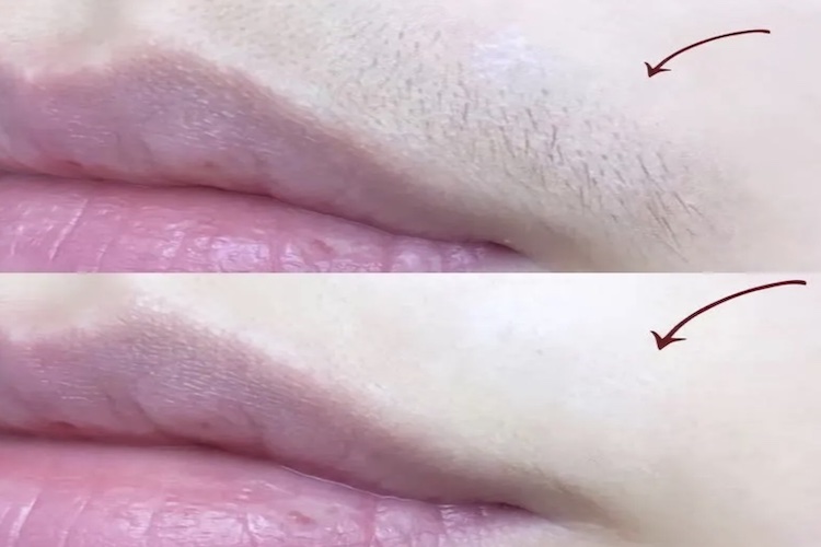 唇部胡须脱毛图