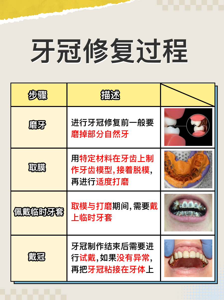 牙冠修复过程图解