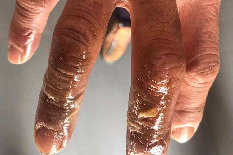 手部皮肤溃烂图