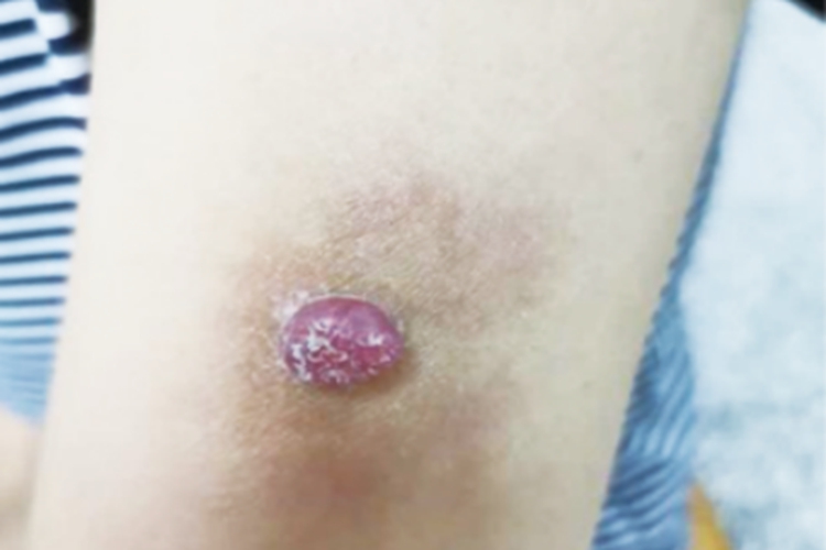 结节型黑色素瘤胳膊症状图