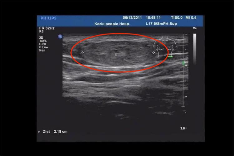 肌间脂肪瘤超声图