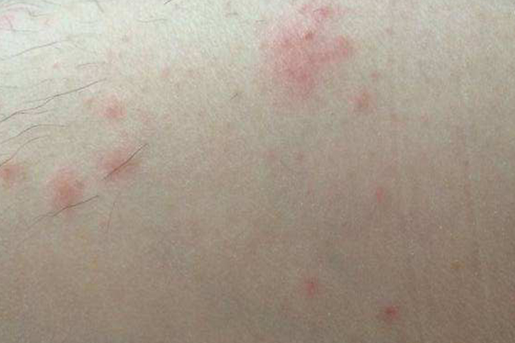 普通小蜘蛛咬伤图 普通小蜘蛛咬伤图