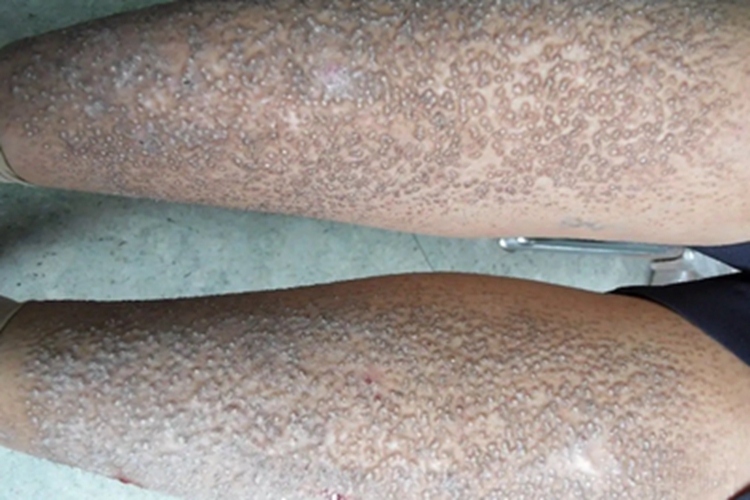 松皮癣小腿疙瘩图 松皮癣小腿疙瘩图