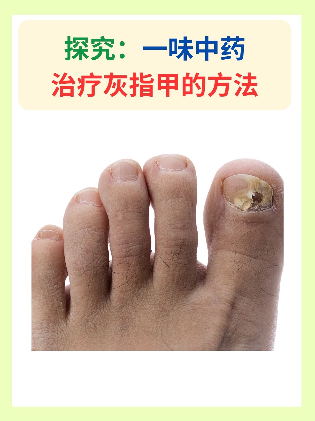 探究:一味中药治疗灰指甲的方法