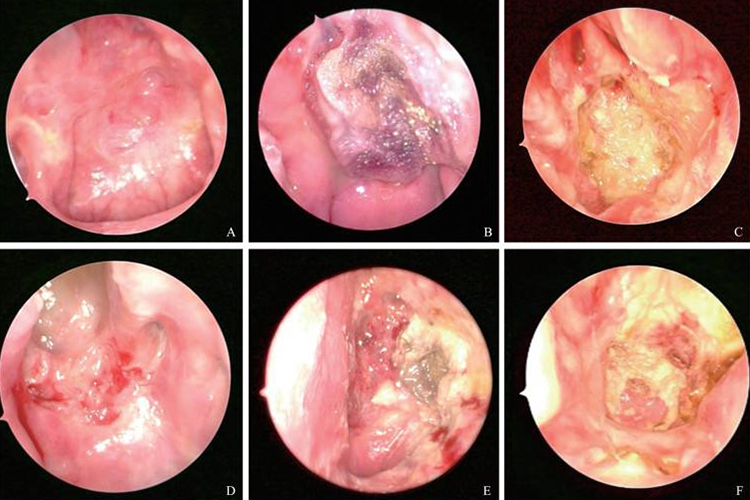 内镜下咽隐窝肿瘤图