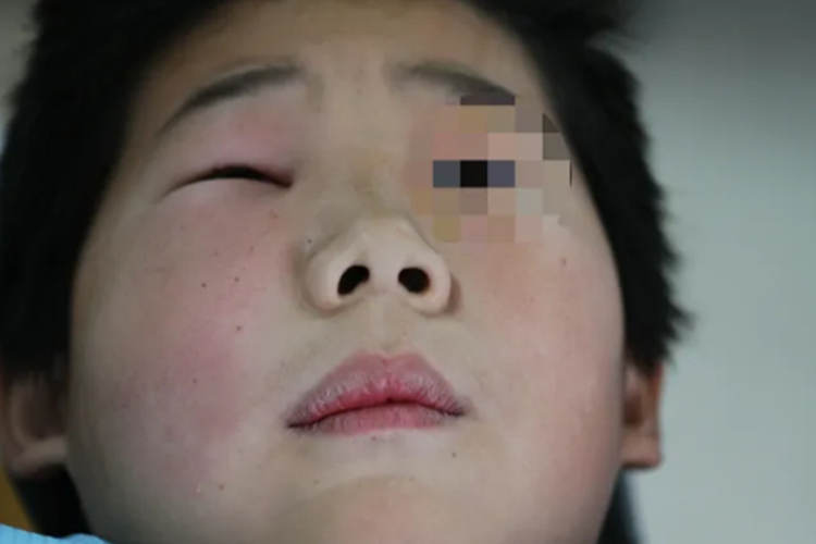 根尖周炎牙疼脸肿图