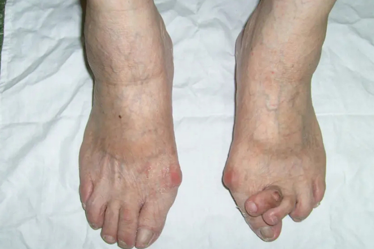 重度拇外翻图 重度拇外翻图