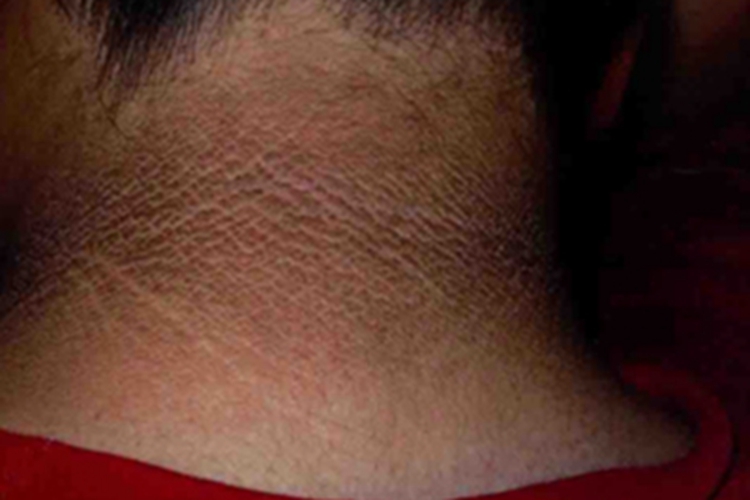 假性黑棘皮病症状图