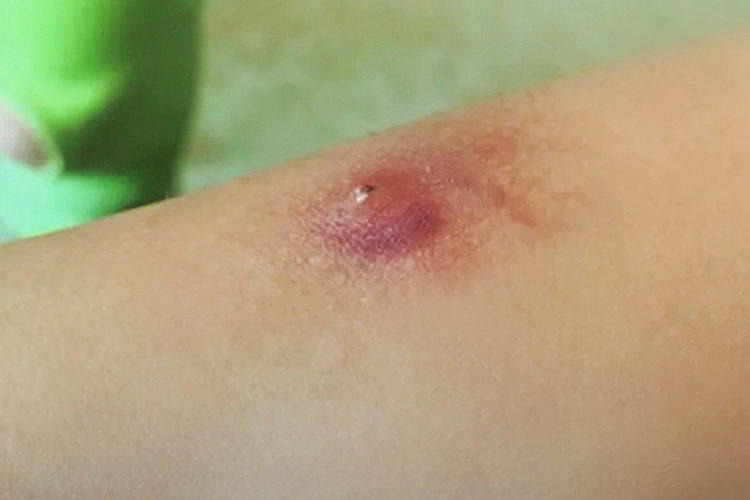 孩子胳膊上皮脂腺囊肿图