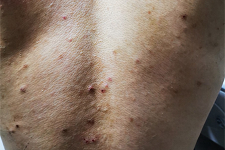 淋巴瘤样丘疹病背部血痂图