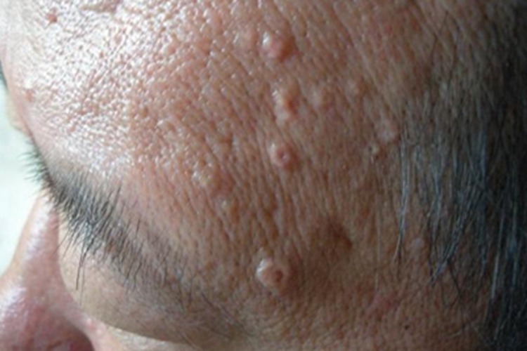 皮脂腺增生圆疙瘩图 皮脂腺增生圆疙瘩图