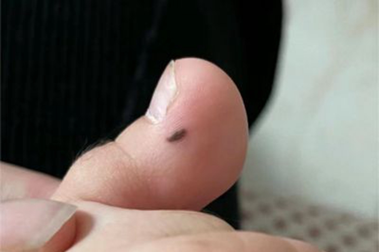 交界痣脚趾黑斑图 交界痣脚趾黑斑图