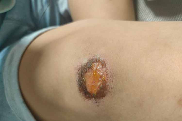 擦伤膝盖症状图