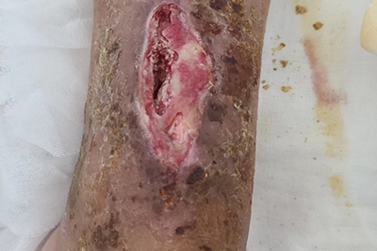 骨折小腿症状图