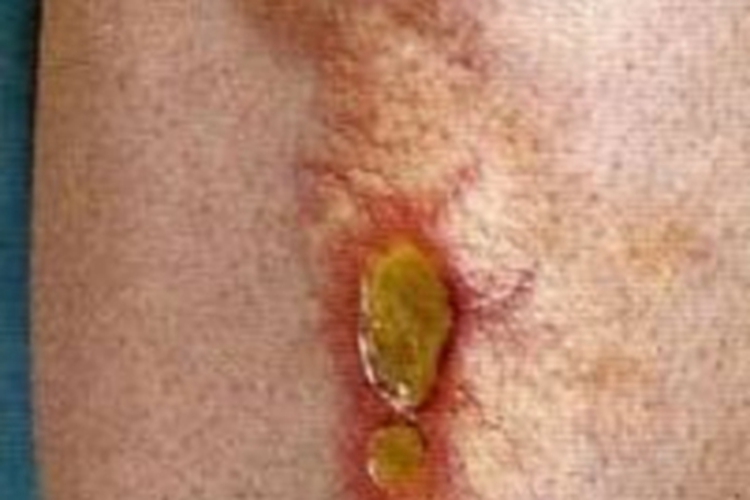 类脂质渐进性坏死皮肤溃疡图