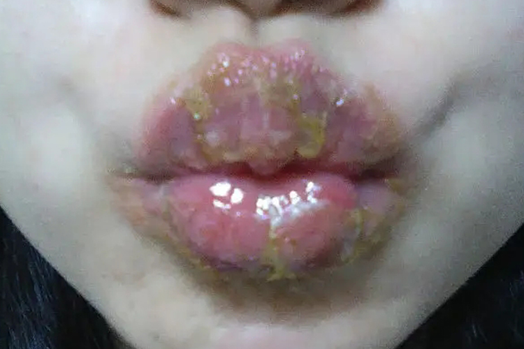 深部化脓性腺性唇炎图