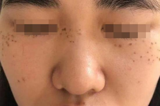 药水点斑结痂开始脱落图 药水点斑结痂开始脱落图