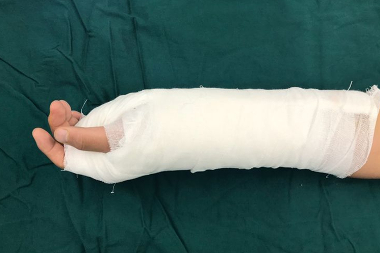 掌指关节脱位固定图 掌指关节脱位固定图