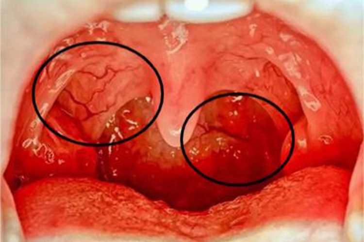 急性咽炎咽喉血丝图