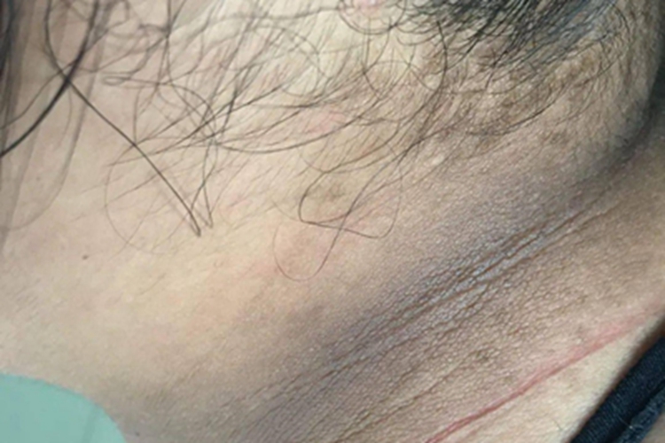 假性黑棘皮病颈部颜色发黑图 假性黑棘皮病颈部颜色发黑图