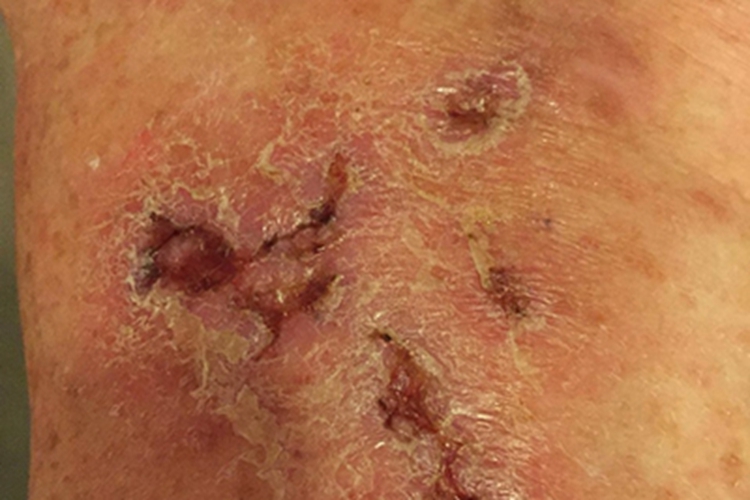 青斑性血管病皮肤脱屑图