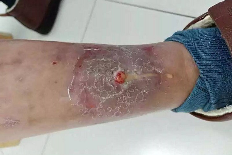 龟分枝杆菌皮肤感染脱屑图