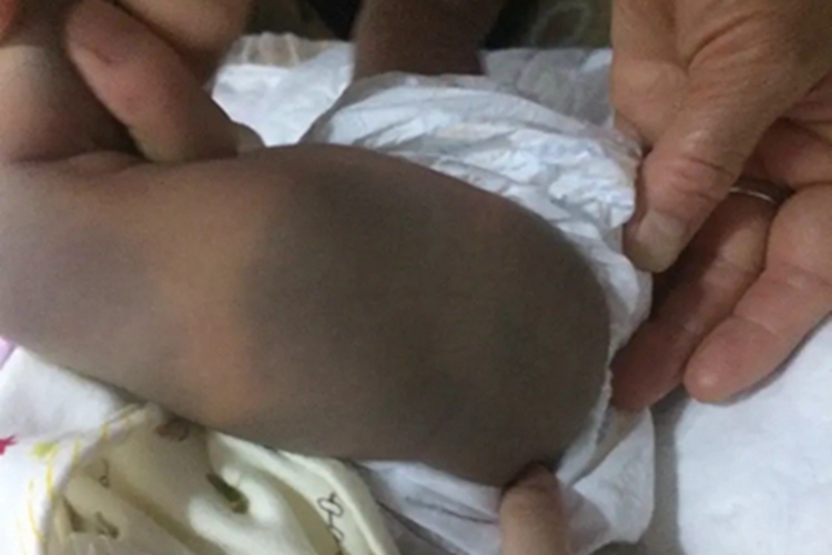 伊藤痣大腿上全是乌青色斑图 伊藤痣大腿上全是乌青色斑图