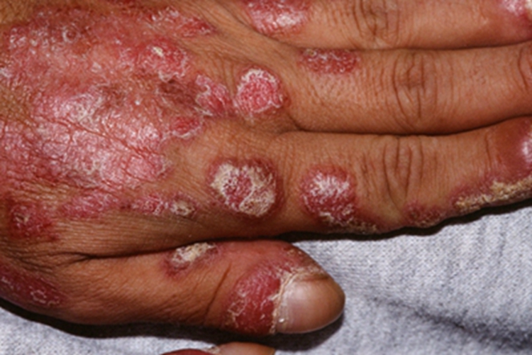 症状艾滋病非感染性皮肤损害可出现在手背处,常表现为局部脱皮