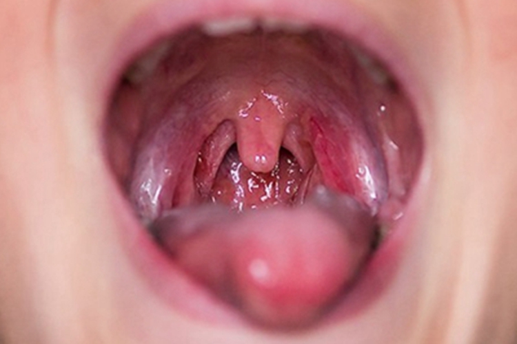 急性咽炎咽喉红肿图