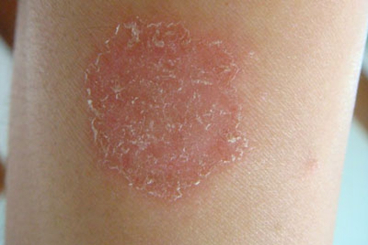 连圈状秕糠疹鳞屑图 连圈状秕糠疹鳞屑图