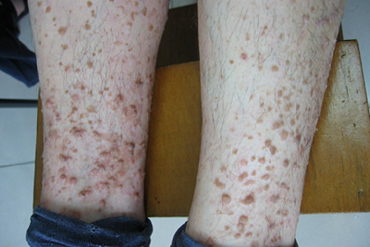 原发性皮肤结核综合征小腿症状图