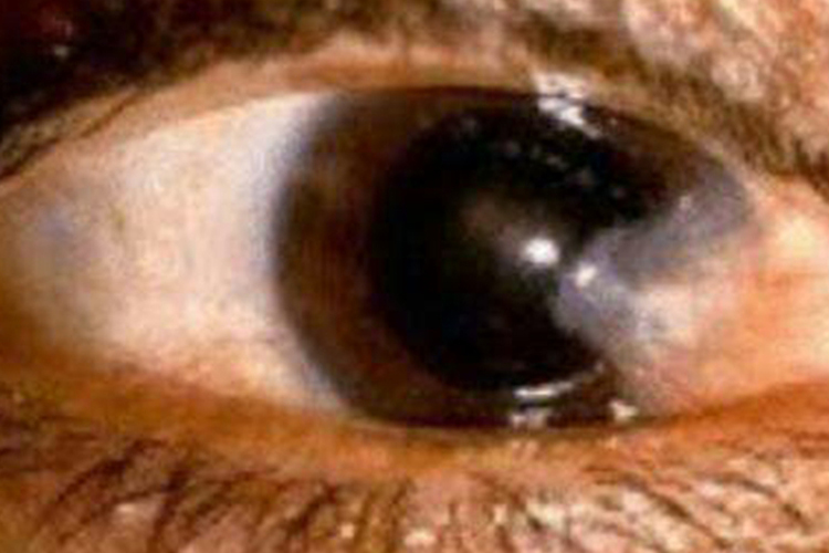 儿童溃疡性睑缘炎图