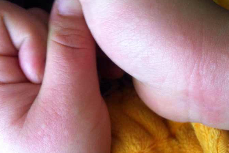 手部过敏症状图