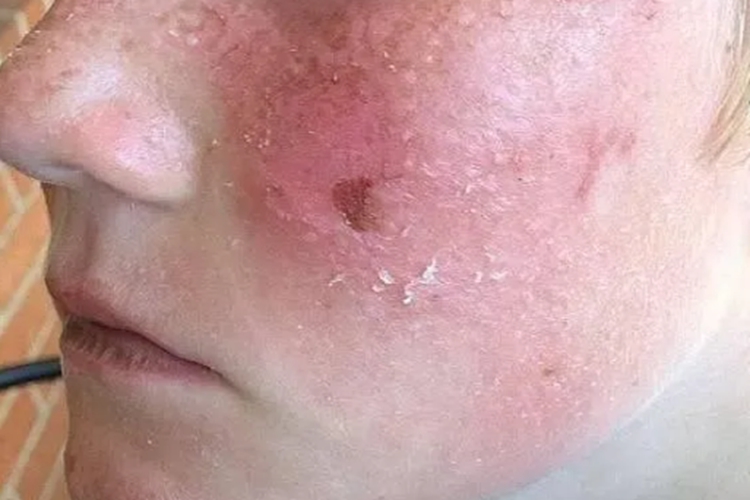 日光性皮炎面部脱屑图