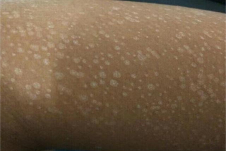 花斑癣胳膊症状图