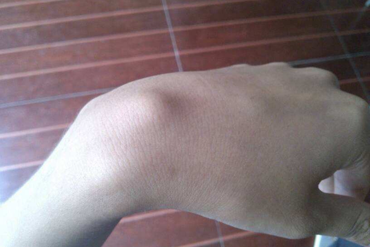 腕背腱鞘炎肿块图