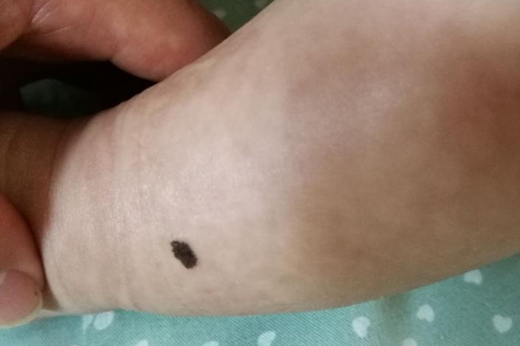 小孩胳膊色素痣图