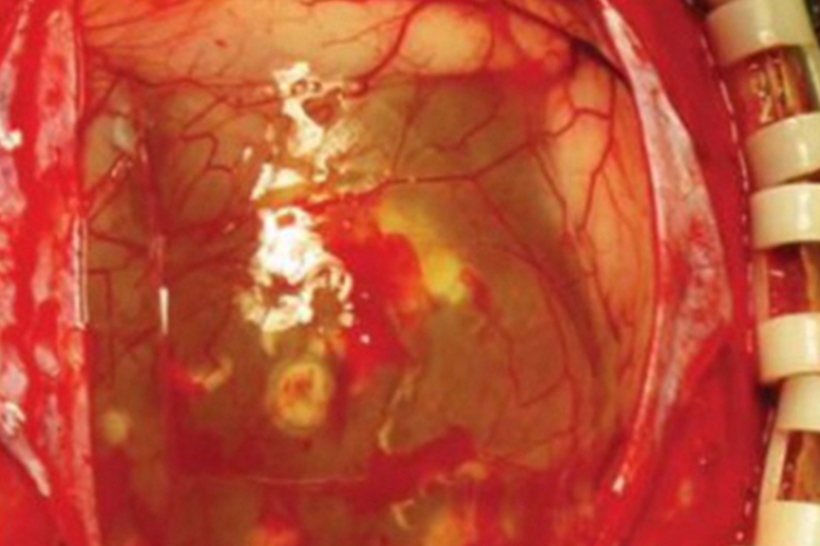 棘球蚴病头部症状图
